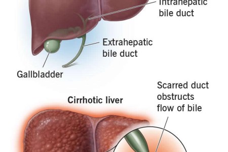Primary Biliary Cholangitis (PBC)