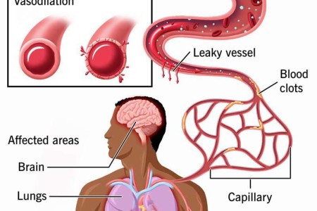 Septic Shock