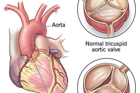 Bicuspid Aortic Valve