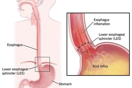 Acid Reflux & GERD
