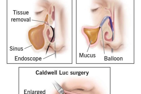 Sinus Surgery