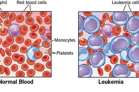 Leukemia