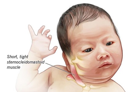 Torticollis