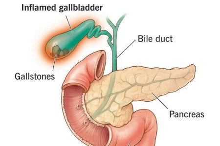 Cholecystitis (Gallbladder Inflammation)