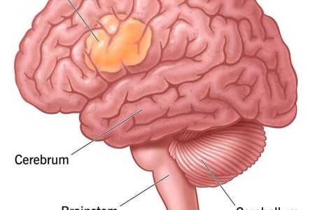 Brain Cancer (Brain Tumor)