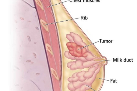 Breast Cancer