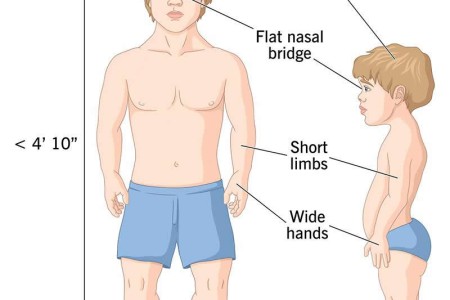 Dwarfism (Skeletal Dysplasia) and Other Causes of Short Stature