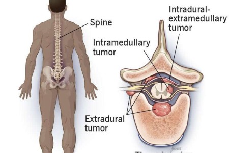 Spinal Tumors