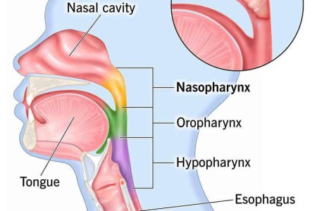 Nasopharyngeal Cancer