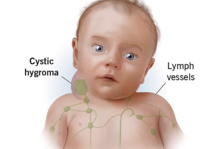 Lymphangioma
