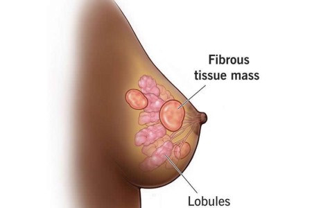 Fibrocystic Breasts