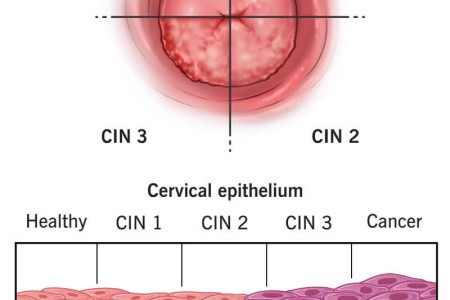 Cervical Dysplasia