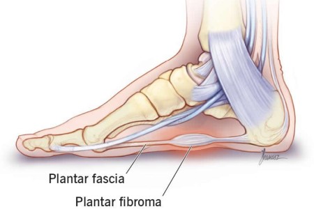 Plantar Fibroma