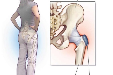 Trochanteric Bursitis