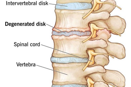 Degenerative Disk Disease