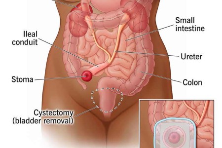 Urostomy