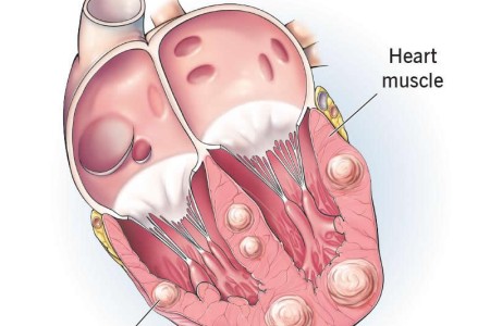 Cardiac Rhabdomyoma