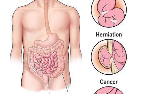 Bowel Obstruction