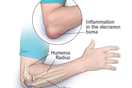 Elbow (Olecranon) Bursitis