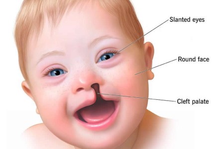 Trisomy