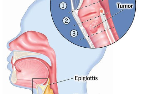 Laryngeal Cancer