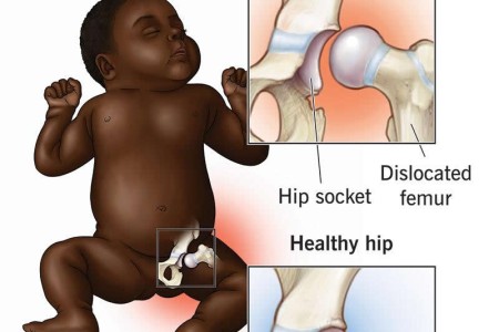 Hip Dysplasia
