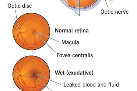 Macular Degeneration
