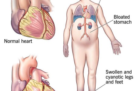 Congestive Heart Failure