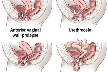 Pelvic Organ Prolapse