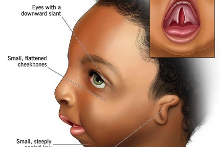 Treacher Collins Syndrome