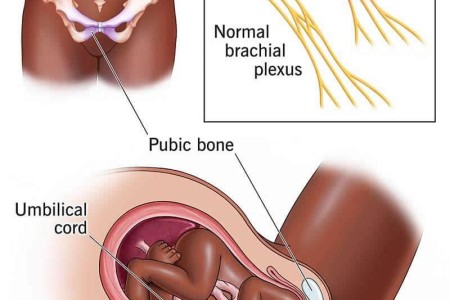 Shoulder Dystocia