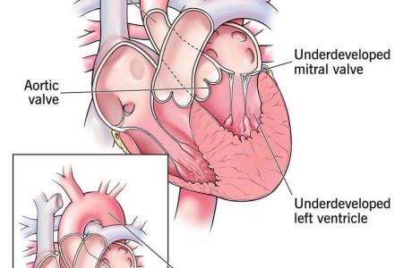 Hypoplastic Left Heart Syndrome (HLHS)