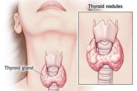 Thyroid Nodules