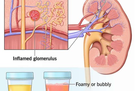 Glomerulonephritis (GN)