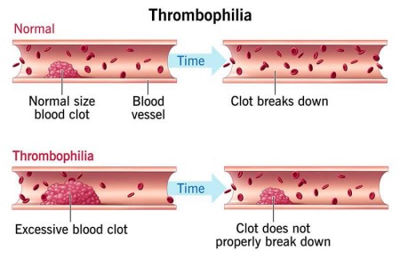 Thrombophilia