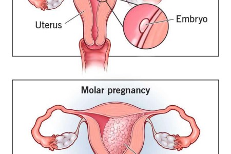 Molar Pregnancy