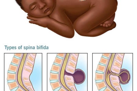 Spina Bifida