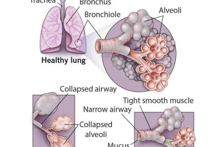 Chronic Obstructive Pulmonary Disease (COPD)
