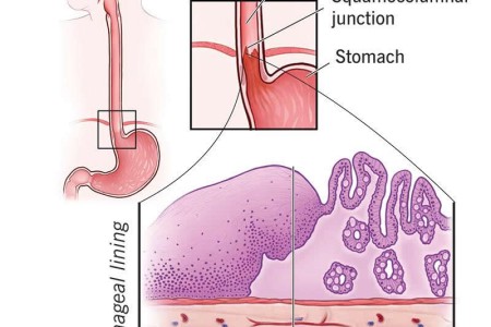 Barrett's Esophagus