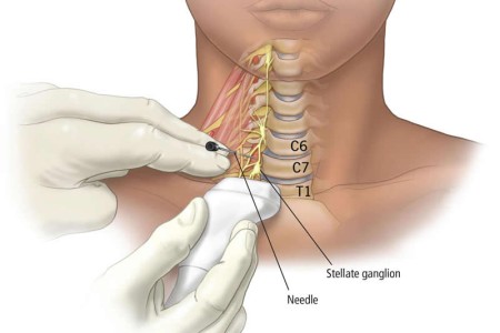 Stellate Ganglion Block