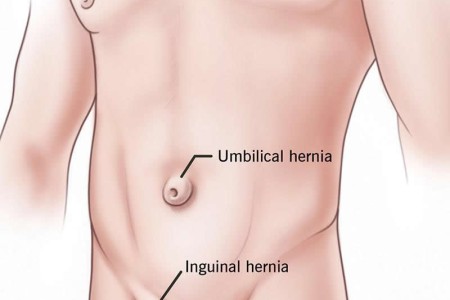 Hernia