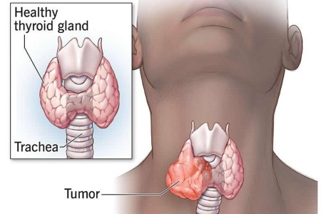 Anaplastic Thyroid Cancer (ATC)