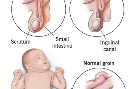Inguinal Hernia in Babies