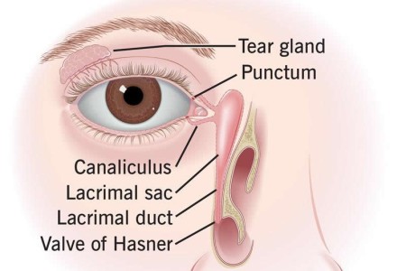 Blocked Tear Duct (Nasolacrimal Duct Obstruction)