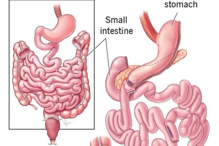 Duodenal Switch