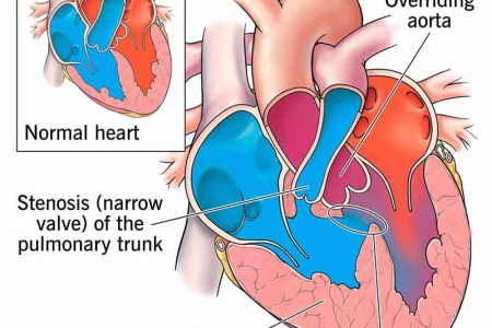 Tetralogy of Fallot