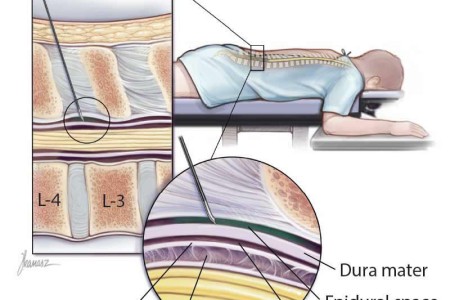 Epidural Steroid Injection (ESI)