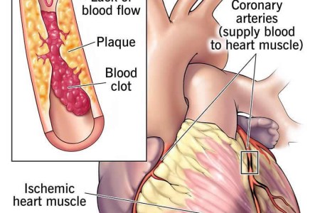 Ischemic Cardiomyopathy