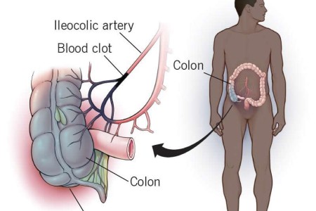 Ischemic Colitis