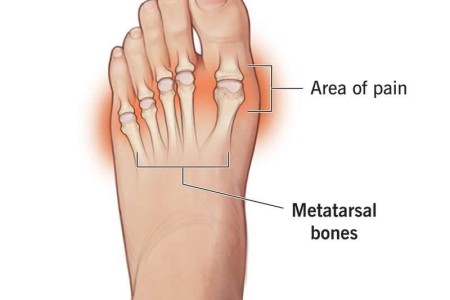 Metatarsalgia
